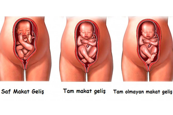 makat gelişli doğum