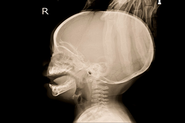 bebeklerde gün batımı senedromu