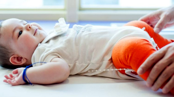 bebekte kalça çıkığına neden olan şeyler