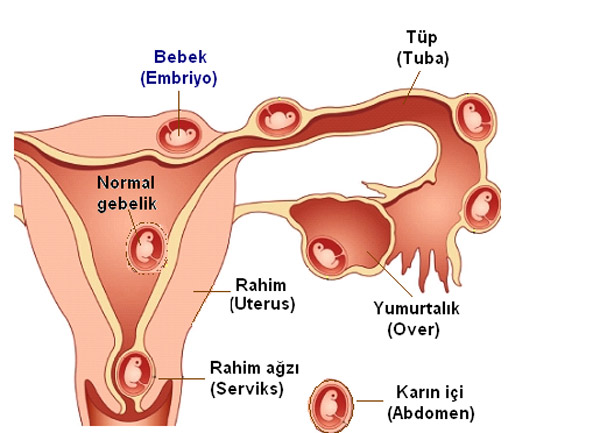 dış gebelik belirtileri