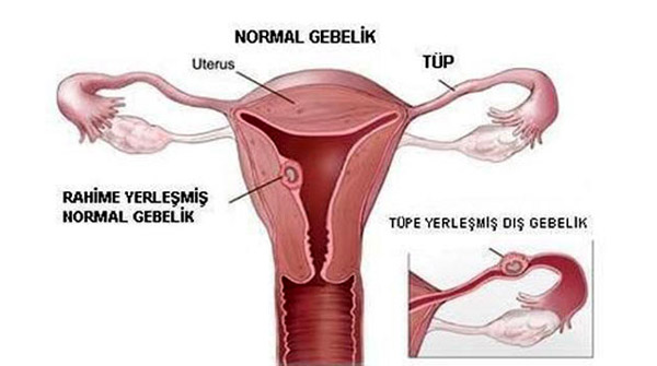 dış gebelik nedenleri