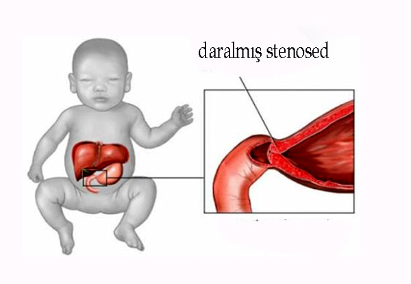 pilor stenozu nedir