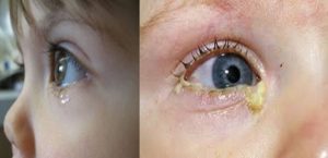 bebeklerin gözü neden çapaklanır