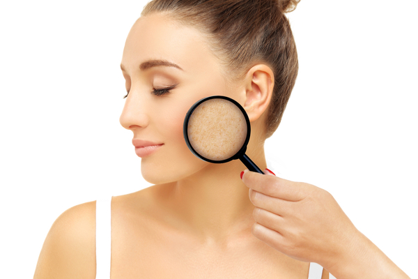 melasma