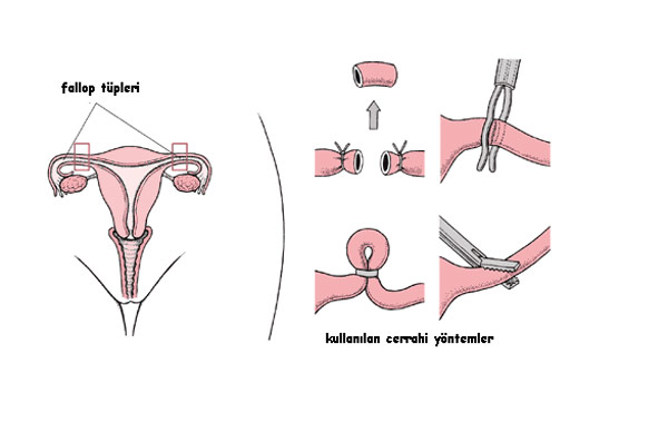 tuplerin-baglanmasi-nasil-olur-