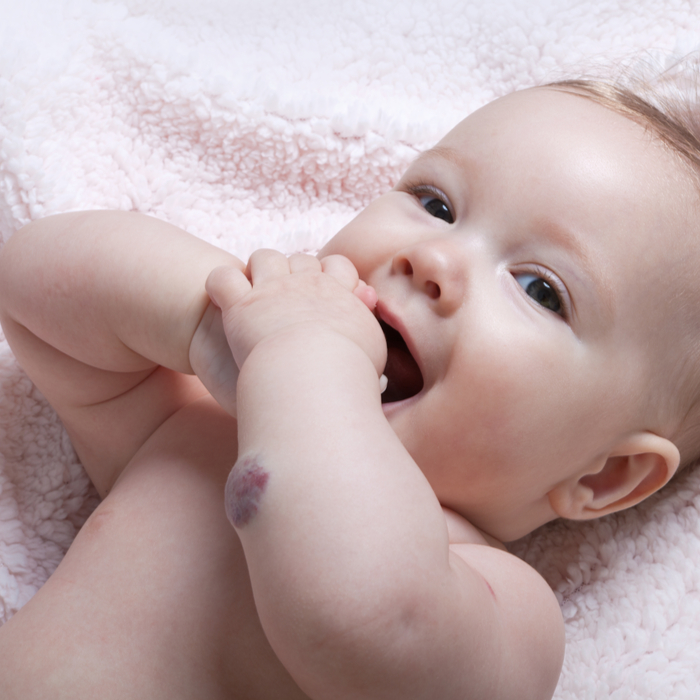 Gebelerin Yedikleri Yiyecekler Doğum Lekesinin Oluşma Nedeni Mi?