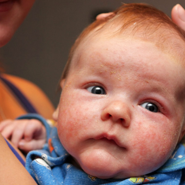 Annelerin Korkulu Rüyası: Atopik Dermatite Karşı Alınabilecek 6 Önlem!