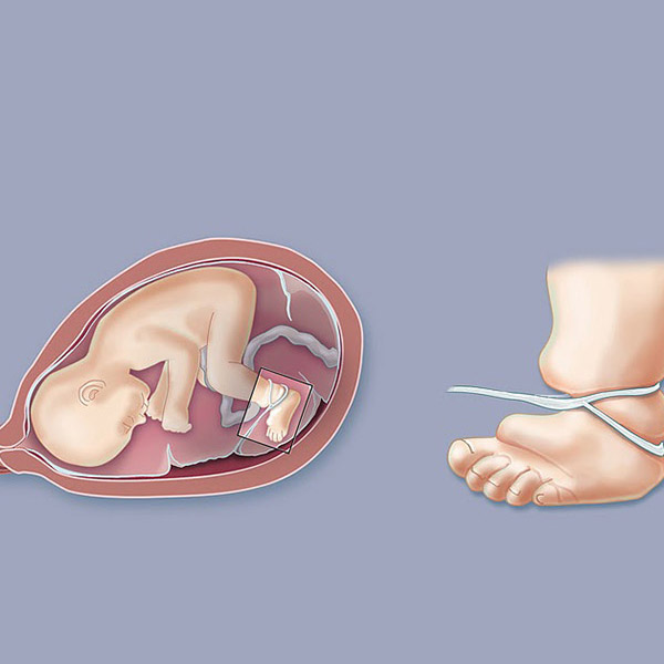Amniyotik Bant Sendromu Ve Bebek İçin Riskleri