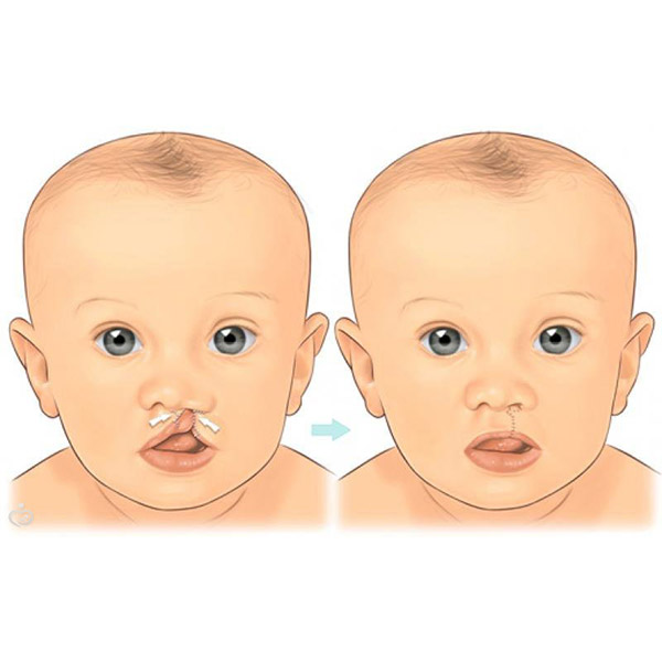 Doğumsal Bir Anomali: Dudak Ve Damak Yarığı Neden Olur?