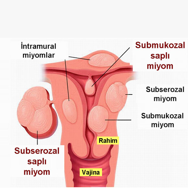 Hamilelikte Miyomun Riskleri Ve Doğum Yöntemine Etkisi