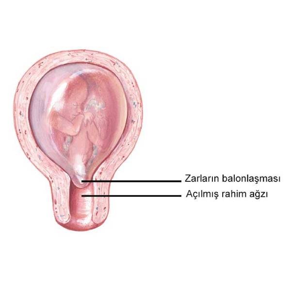 Rahim Ağzı Dikişi (serklaj) Nedir, Neden Yapılır?