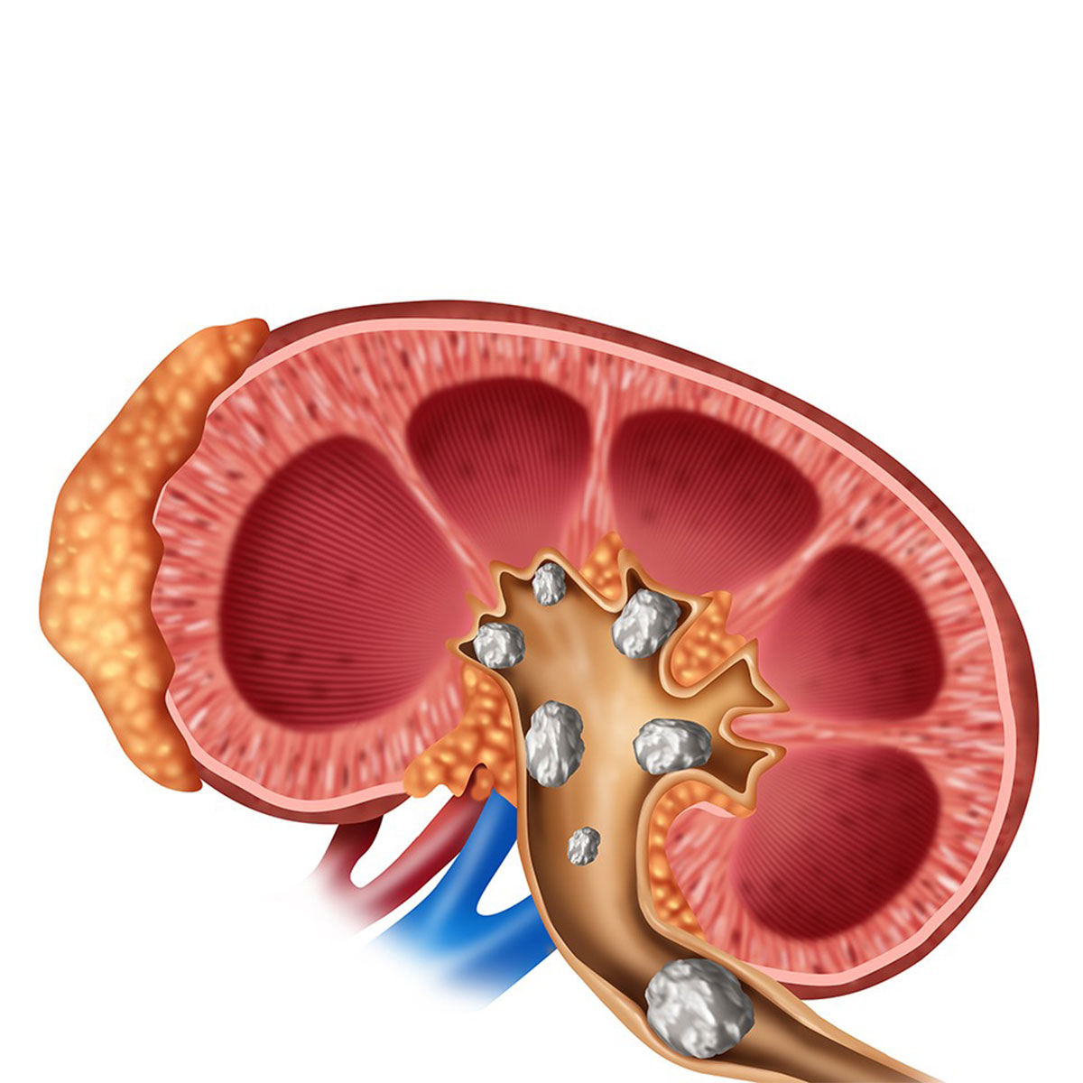 Hamilelikte Böbrek Taşı Nasıl Tedavi Edilir?