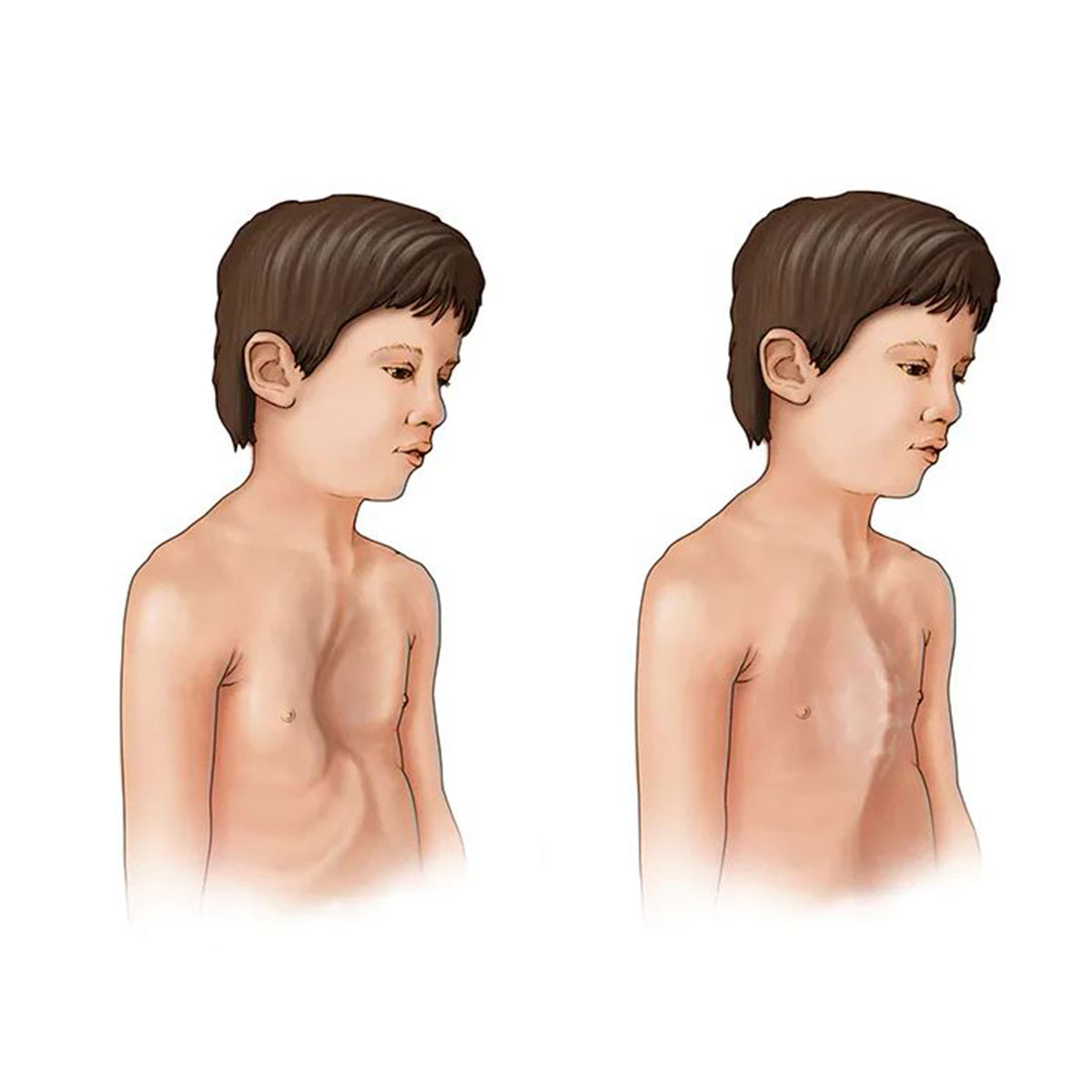 Marfan Sendromu Nedir? Belirtileri, Nedenleri Ve Tedavisi